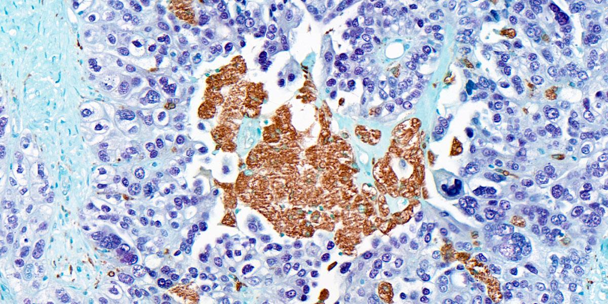CD68+ tumour associated macrophages (brown) within a human high-grade serous ovarian cancer omental metastasis