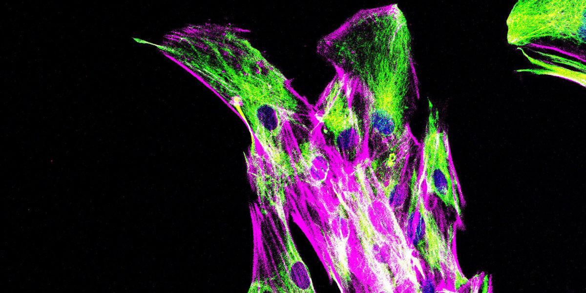 Immunofluorescence staining of cancer-associated fibroblasts from a human pancreatic cancer