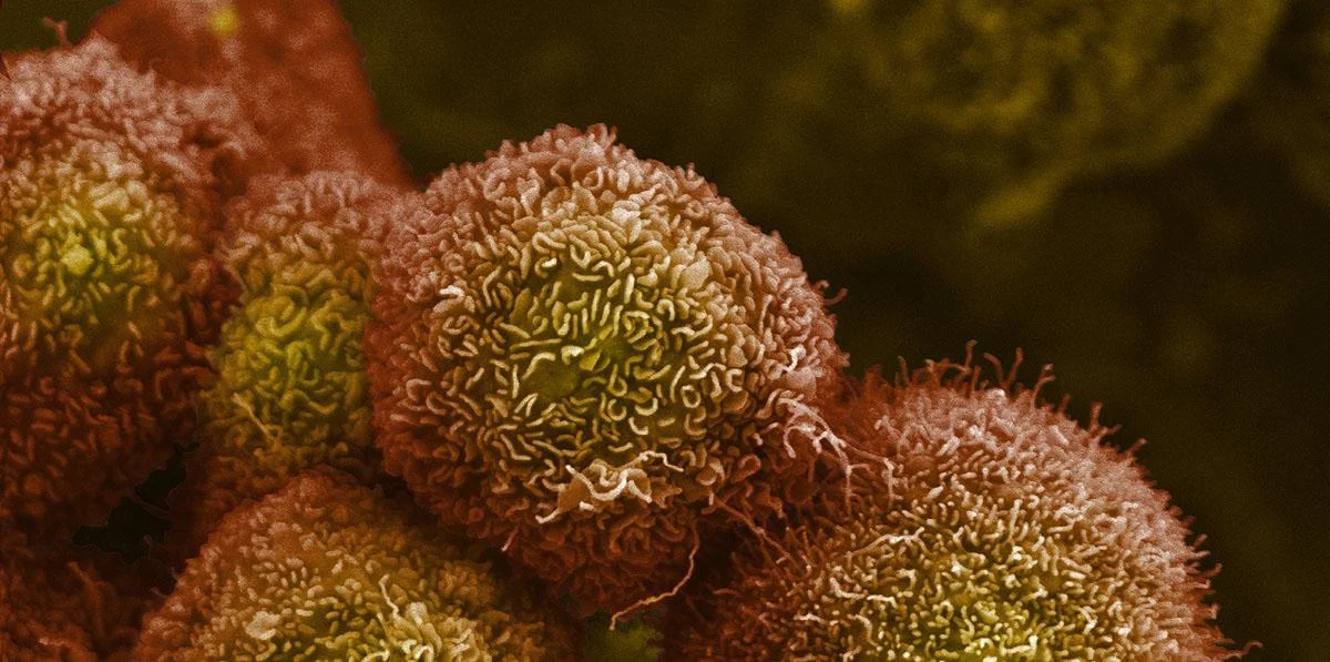 Pancreatic cancer cells. Credit: Anne Weston, Francis Crick Institute. CC BY-NC
