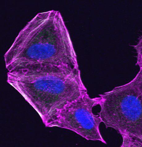 Researchers have found that melanoma cells fight anti-cancer drugs by changing their internal skeleton (cytoskeleton) - opening up a new therapeutic route for combatting skin and other cancers that develop resistance to treatment. This image shows a drug-resistant melanoma cell that has altered its cytoskeleton.