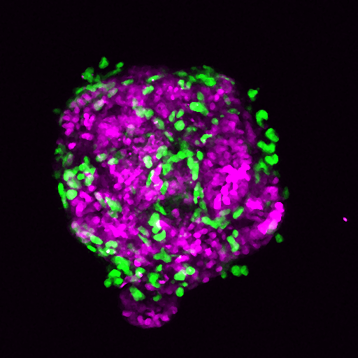 Cancer cell spheroids. Cancer cells (purple) growing in 3D culture with fibroblasts (green). The two cell types cooperate to promote growth and invasion. Image by Liz Murray and Ed Carter