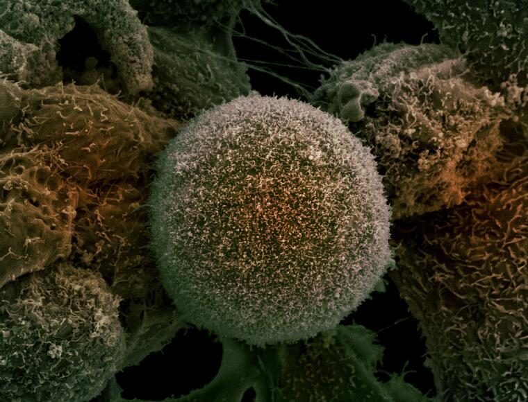 Scanning electron microscopy image of a cluster of prostate cancer cells.