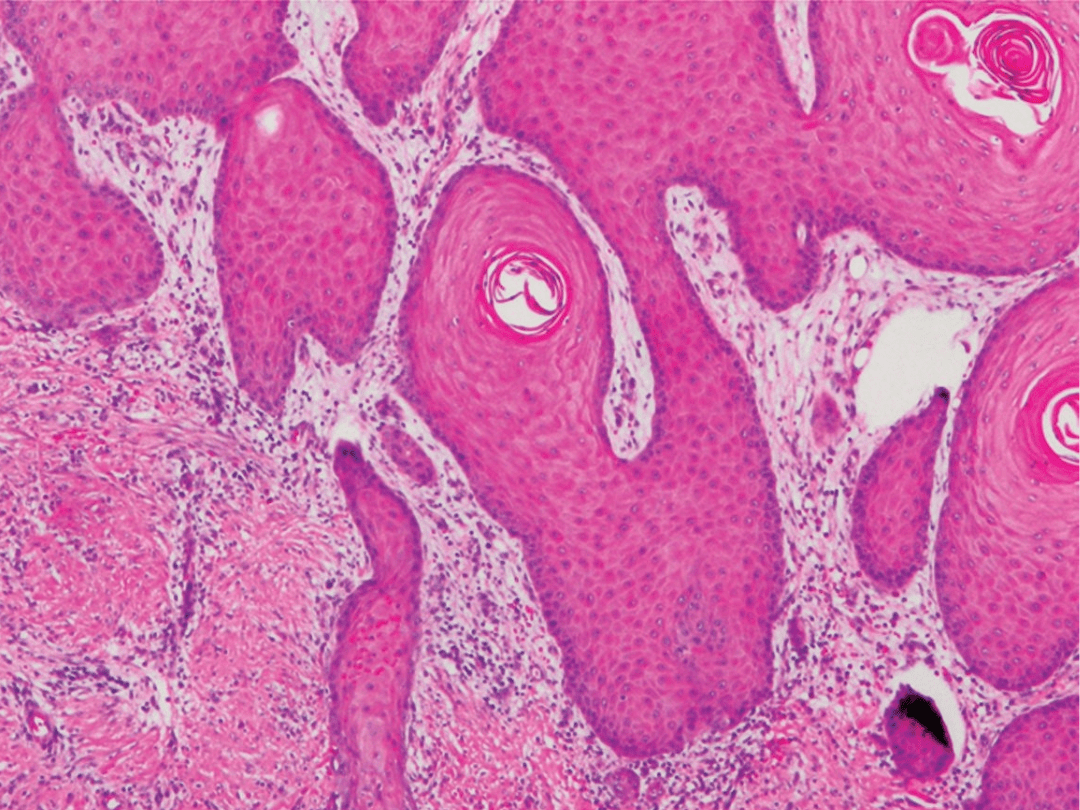 Skin tissue with cutaneous squamous Cell Carcinoma. Copyright © 2011 Valerie R. Yanofsky et al. CC-BY 3.0