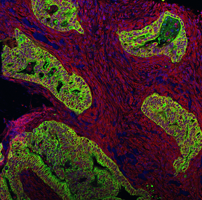 Pancreatic ductal adenocarcinoma (PDAC) in patient tumour tissue, stained for cancer cells (green, cytokeratin) and CRABP2 (red). The cancer cells are surrounded by a dense desmoplastic stroma comprising activated myofibroblasts, which stain positive for CRABP2.
