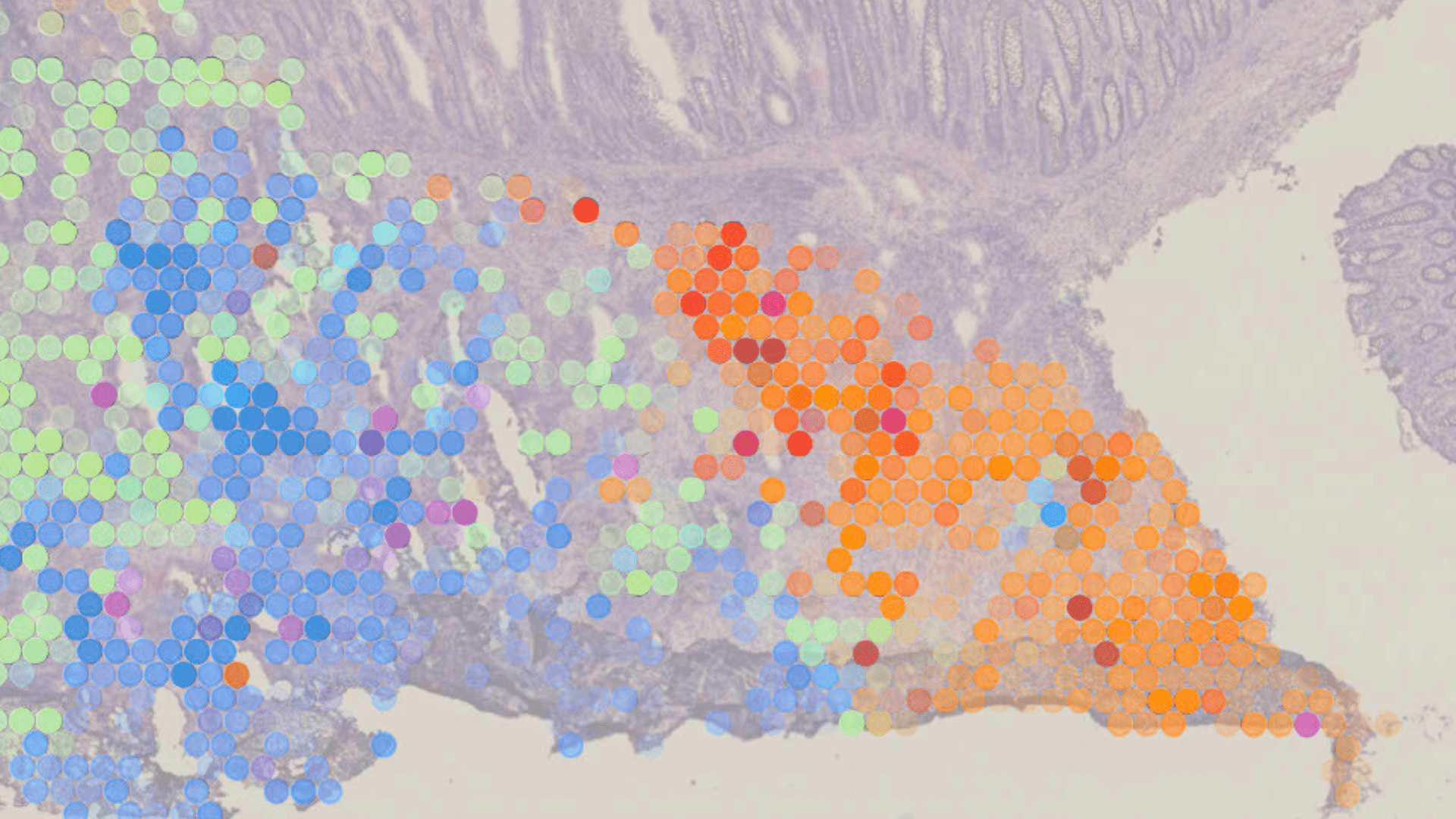 Coloured circles show cancer cell states mapped onto a tissue sample from a patient with bowel cancer.
