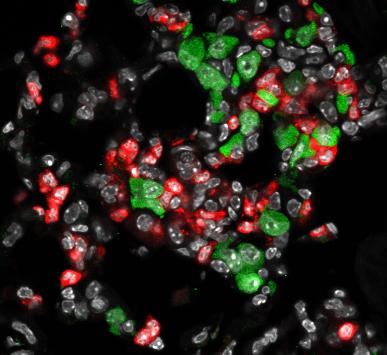 Tissue section of a metastatic lung: breast cancer cells (in green) are colonising and growing a metastasis in the lung; neutrophils (in red) are among the cells most abundantly infiltrating the local tumour environment at early stages of metastasis.
