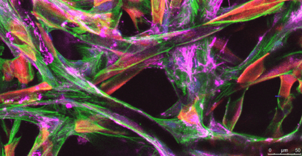 3D printed scaffold seeded with patient-derived mesothelial cells Red: Calretinin Magenta: Vimentin Green: Cytoskeleton Blue: Nuclei