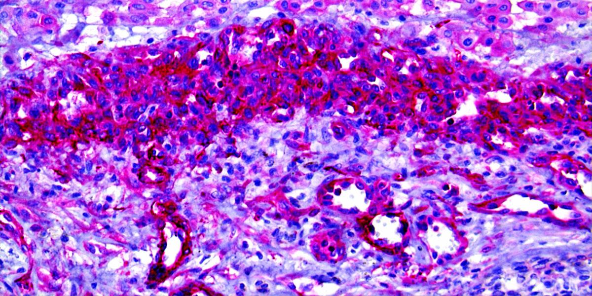 Melanoma myosin ring: "ring" of invasive melanoma cells with high Myosin II activity (pink) at the invasive margin of the tumour