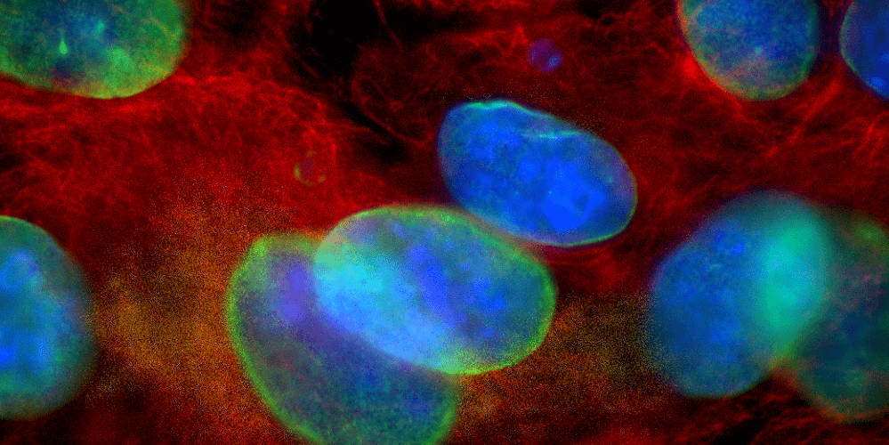 Ovarian cancer image by Molly Guscott, McClelland Lab