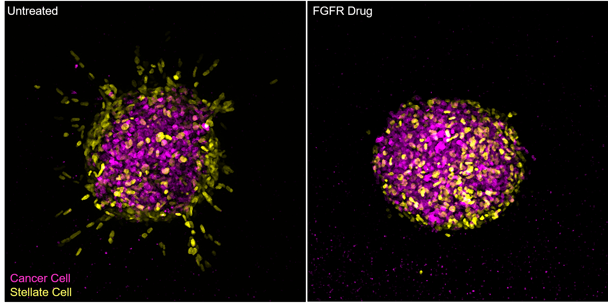 3D spheres of cancer cells (shown in purple) and stellate cells (shown in yellow). In untreated conditions (shown in the left panel of the image), stellate cells invade into the surrounding tissue, creating tracks for the cancer cells to follow. When treated with an FGFR inhibitor (shown in the right panel), this invasion is blocked and the cells remain in the central sphere.