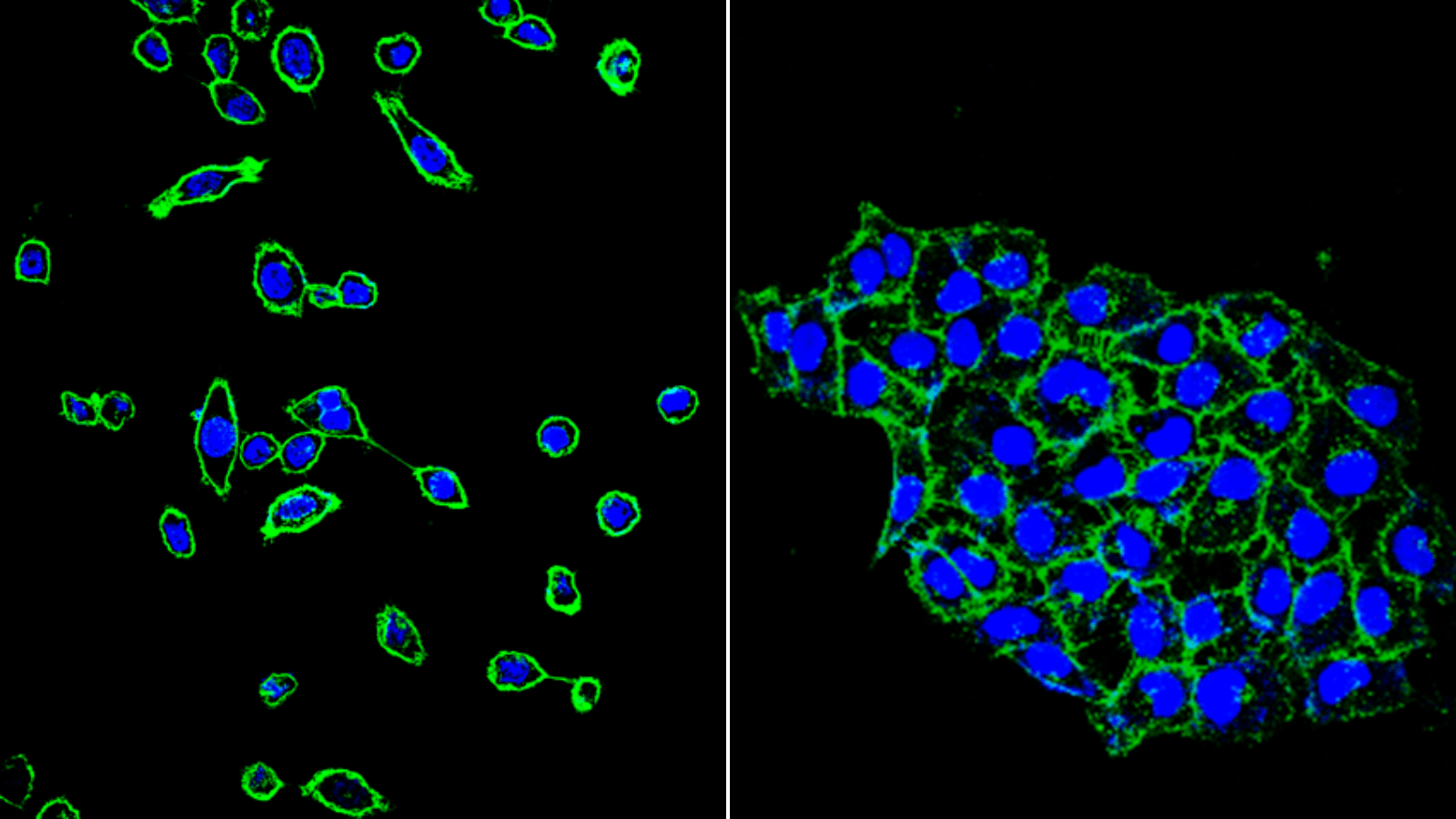 Human lung cells (blue: DNA, green: cell boundaries). When the faulty MET (METex14) is present, cells move apart from each other: the first step of cancer spread (left). A drug targeting the faulty MET blocks the cell movement (right).