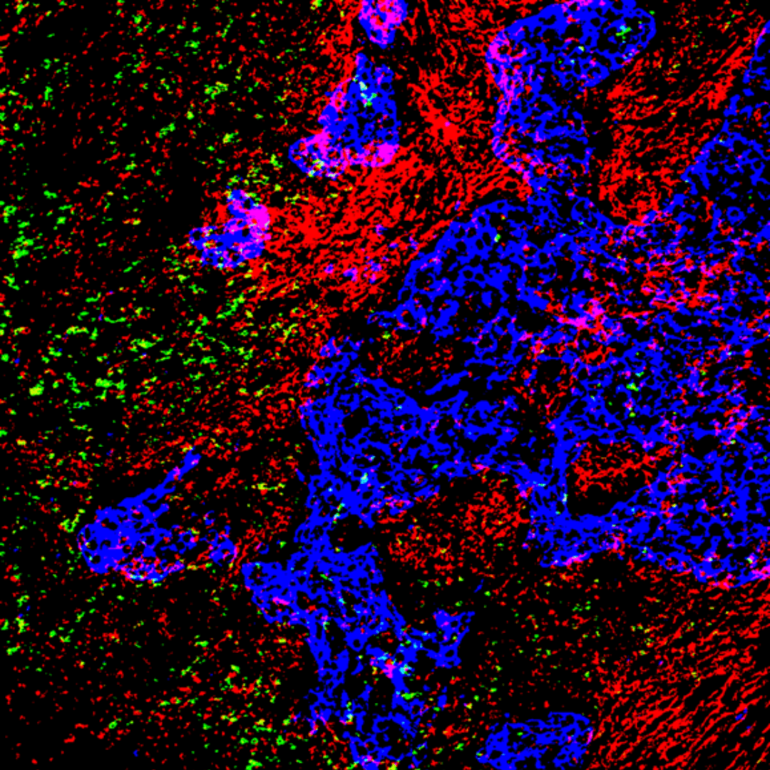 A tissue section of triple negative breast cancer, showing the location of versican (red) when around tumour islands (blue) associates with reduced T-cells (in green) in contact with tumour.